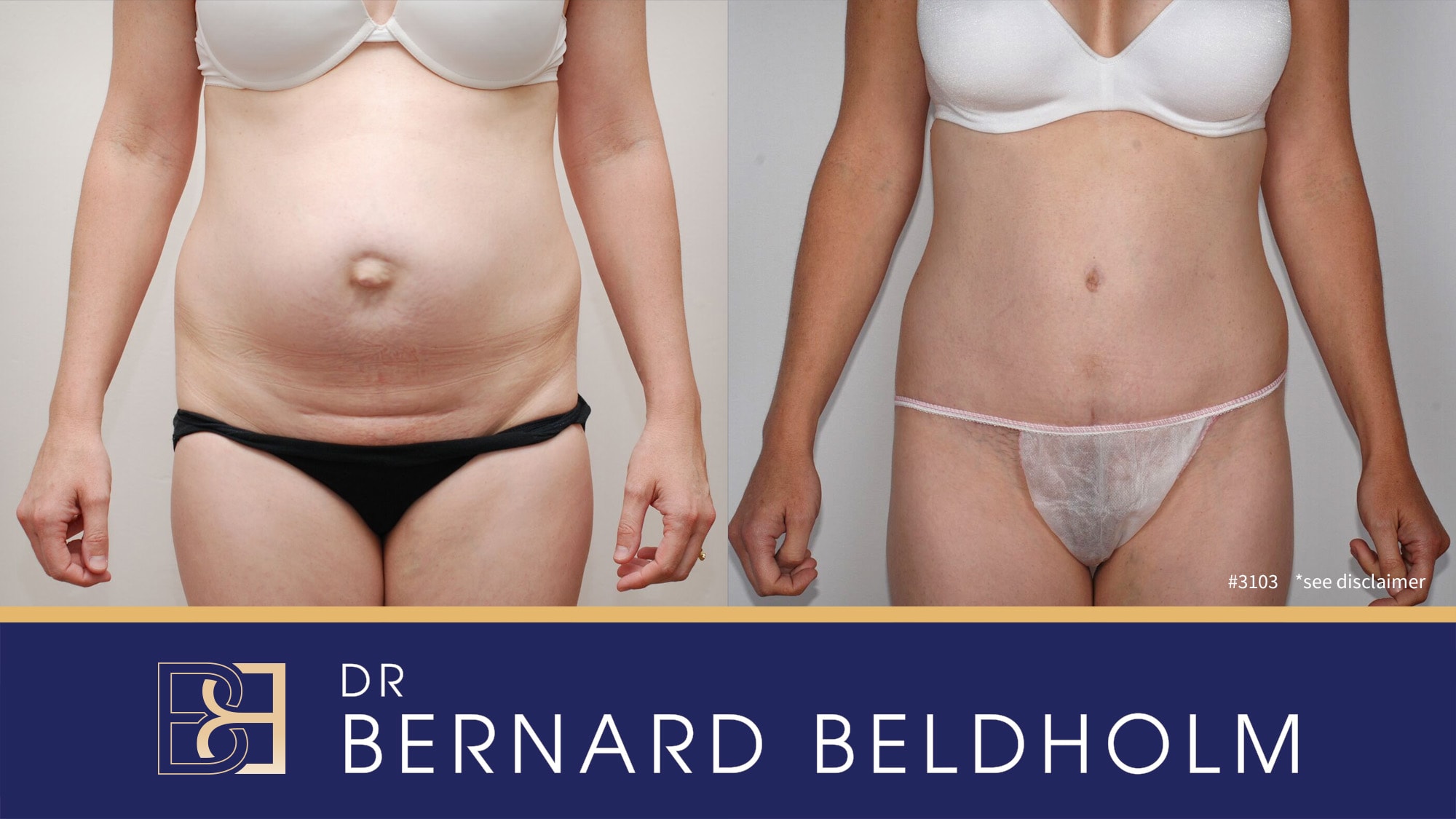 Abdominoplasty performed for diastasis recti by Dr Beldholm