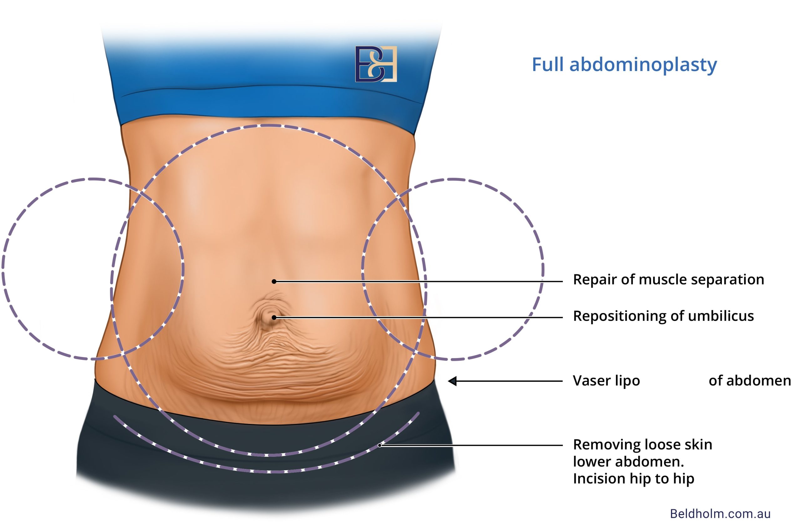 Dr Beldholm's post pregnancy full abdominoplasty