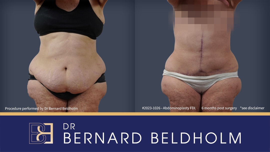 Fleur de lis abdominoplasty | Dr Beldholm