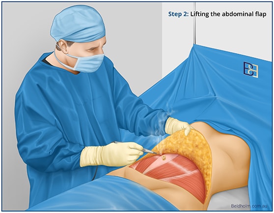 Dissecting the skin in an abdominoplasty | Dr Beldholm