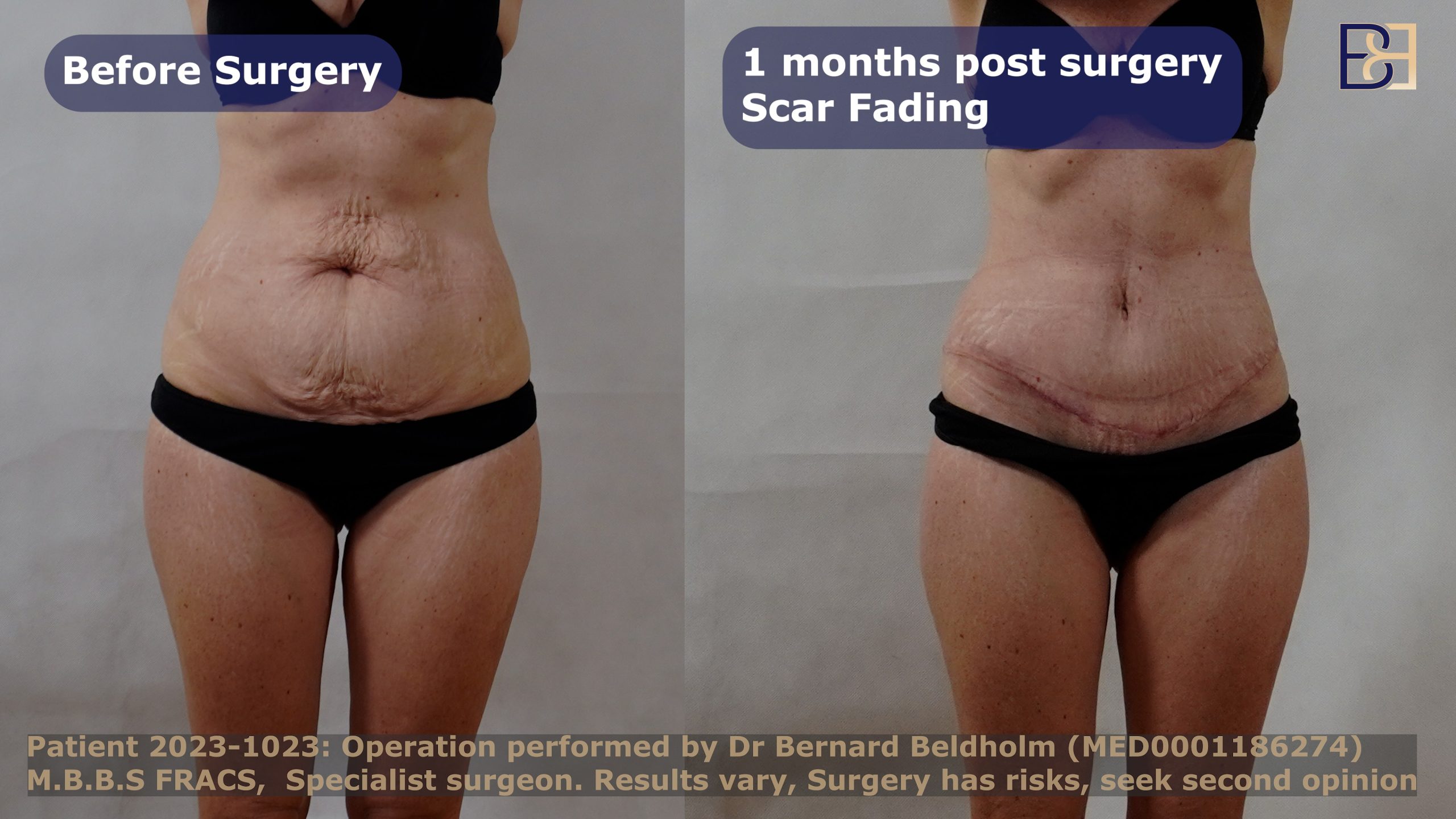 Abdominoplasty performed by Dr Beldholm Before and After