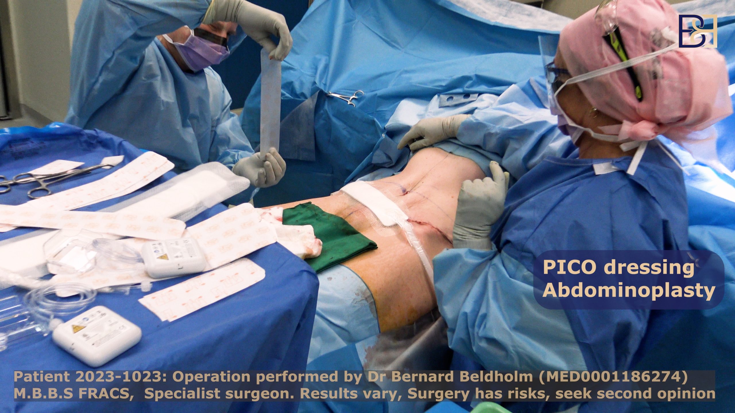 Dr Beldholm applying PICO dressings at the end of an abdominoplasty