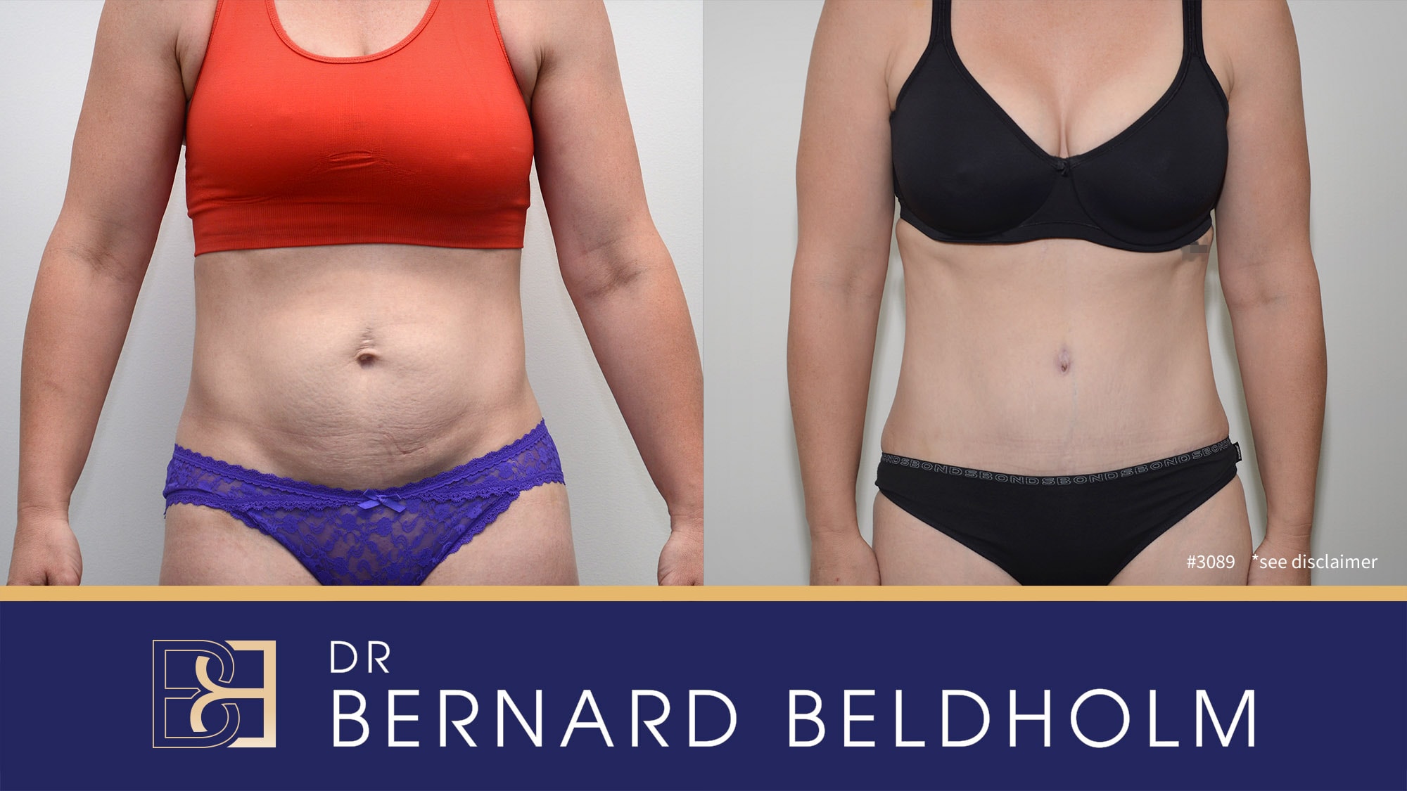 Before & After of abdominoplasty for diastasis recti performed by Dr Beldholm