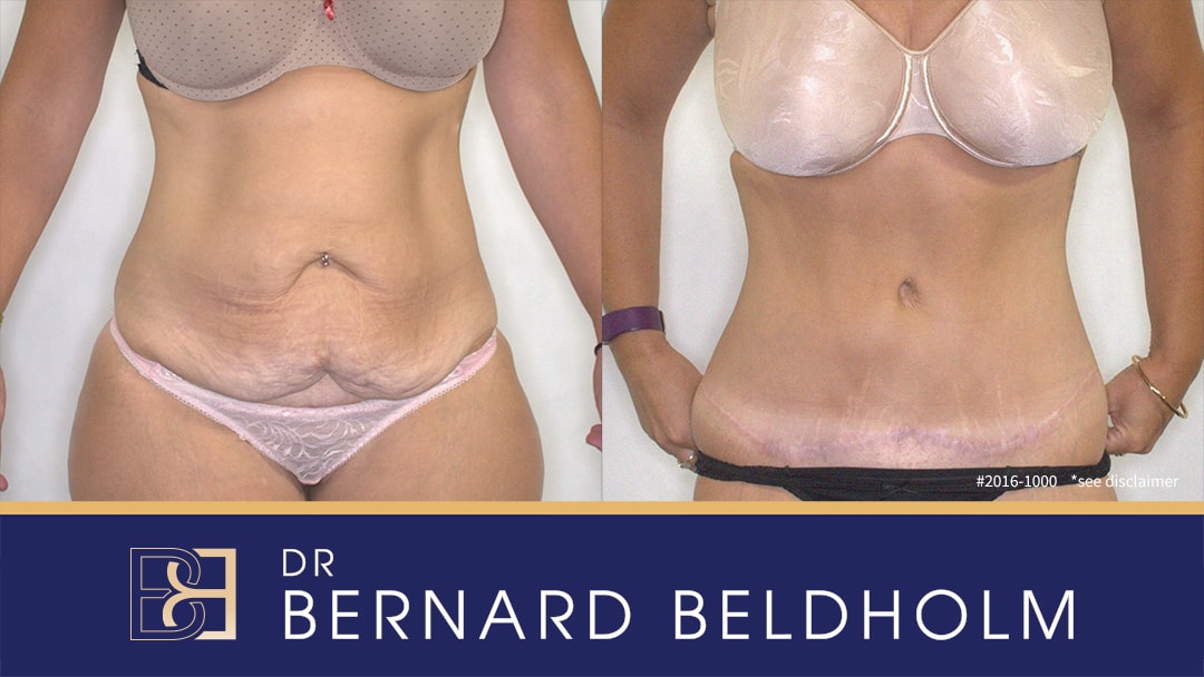 Abdominoplasty post weight loss performed by Dr Beldholm