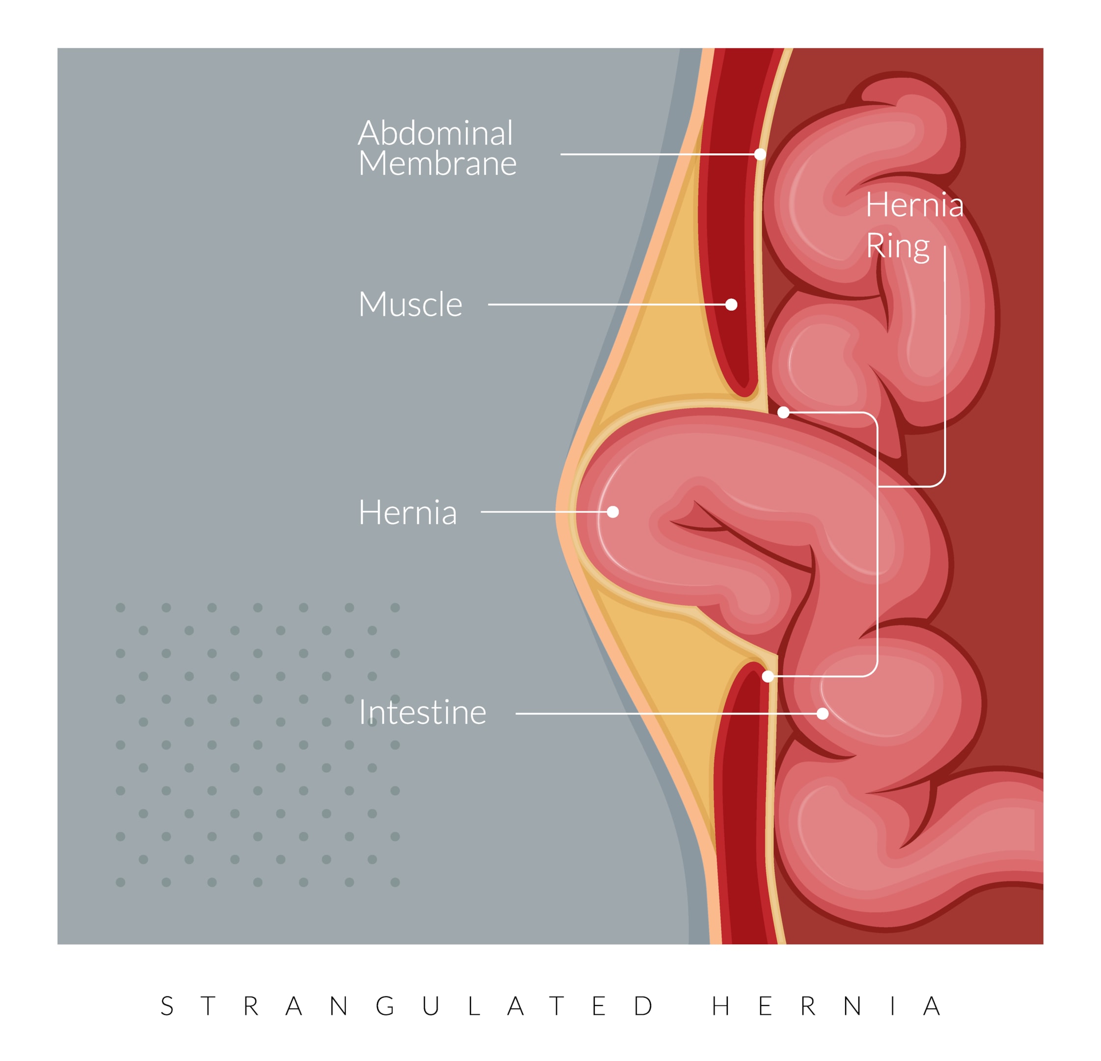 Hernia | Dr Beldholm