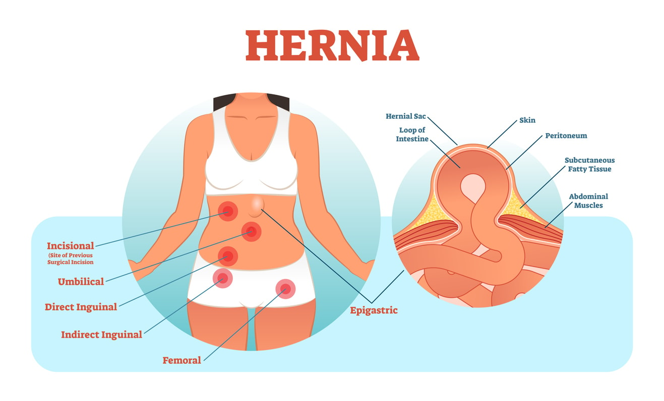 Different abdominal wall hernias | Dr Beldholm