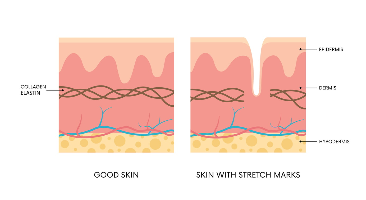 Stretch marks | Dr Beldholm