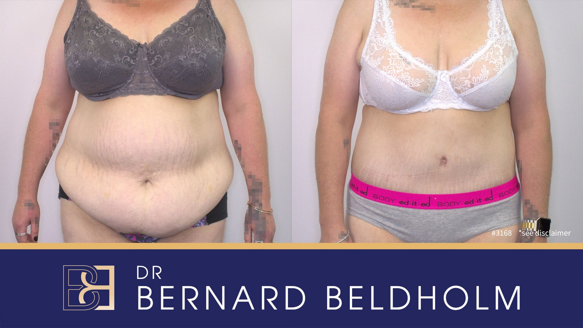 Abdominoplasty post pregnancy performed by Dr Bernard Beldholm