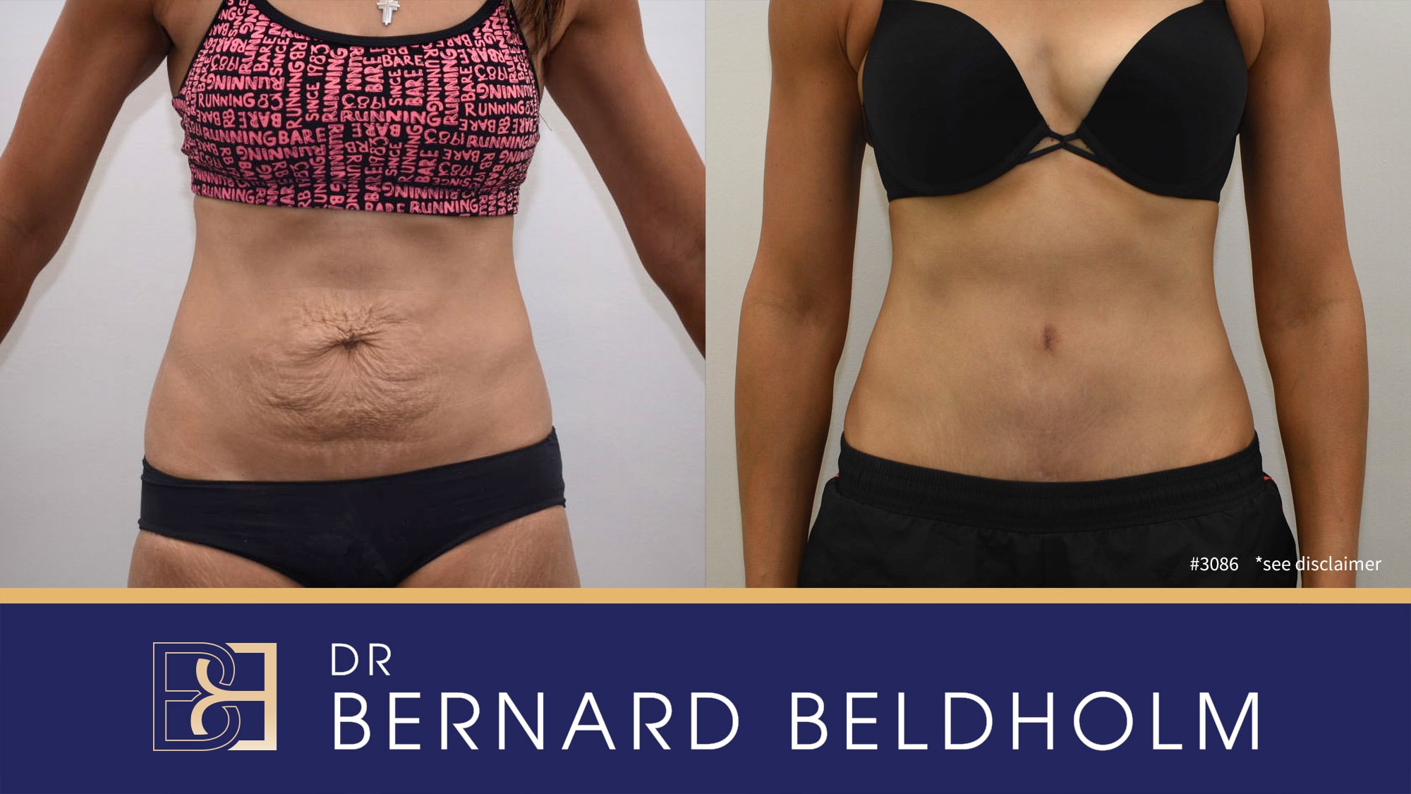 Full abdominoplasty performed by Dr Beldholm