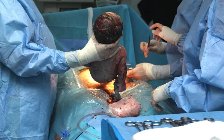 C-section delivery