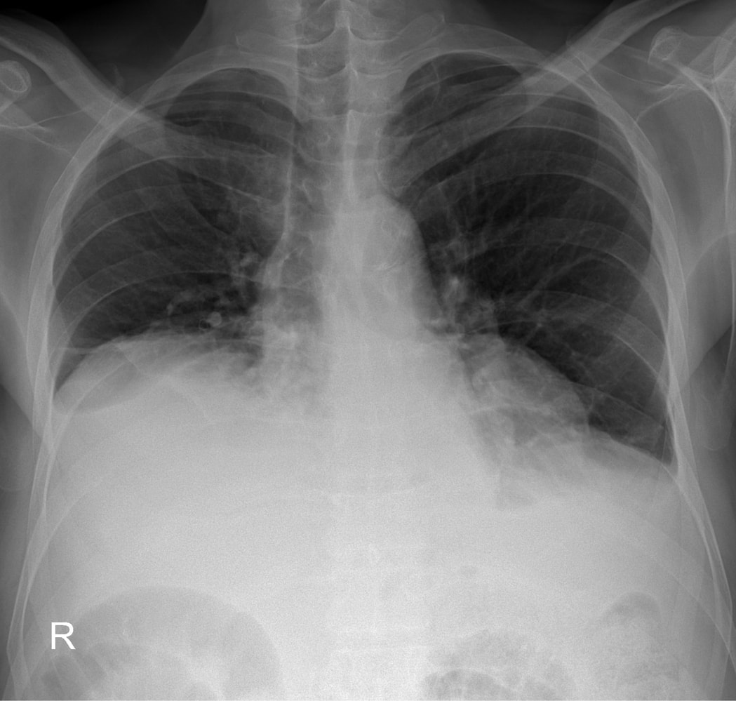 Lung atelectasis post surgery - poor inspiratory effort | Dr Beldholm