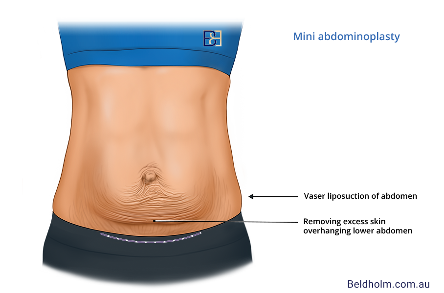 An illustration depicting the concept of mini abdominoplasty, highlighting the surgical area and techniques involved.