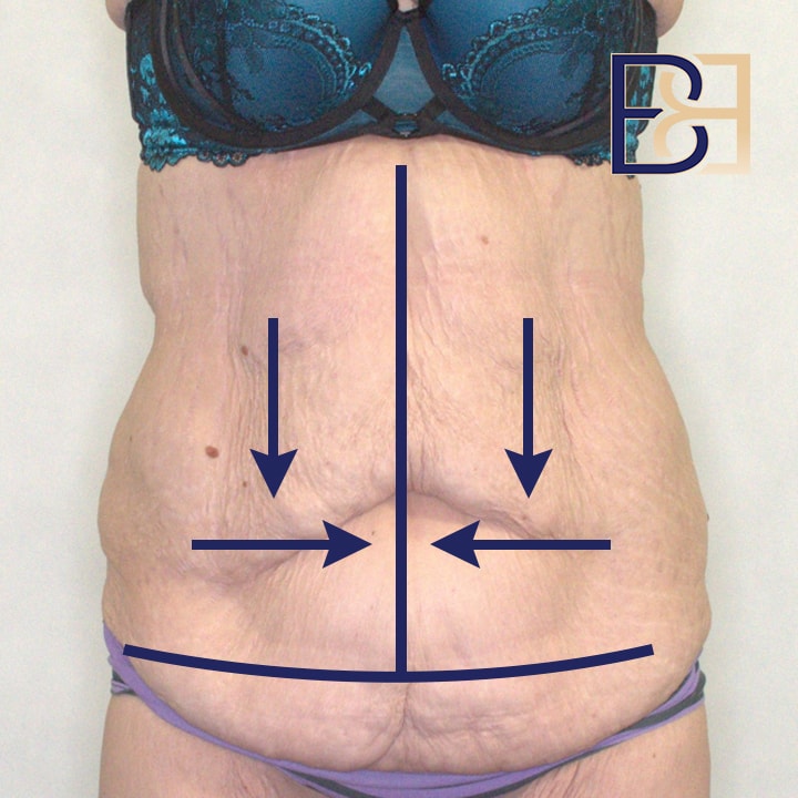 An illustration depicting the benefits of a vertical incision abdominoplasty, showcasing the tighter appearance of the abdomen.