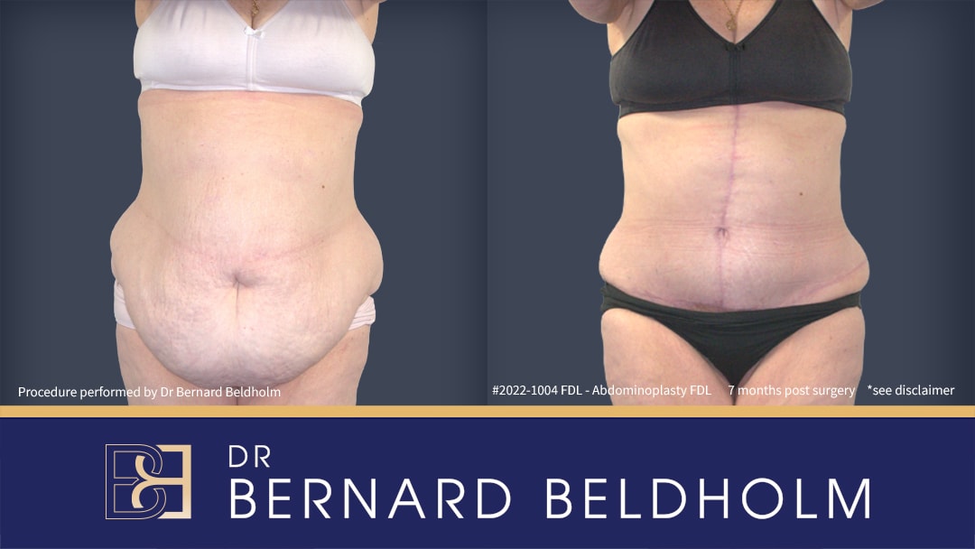 Fleur de lis abdominoplasty post weight loss done by Dr Beldholm