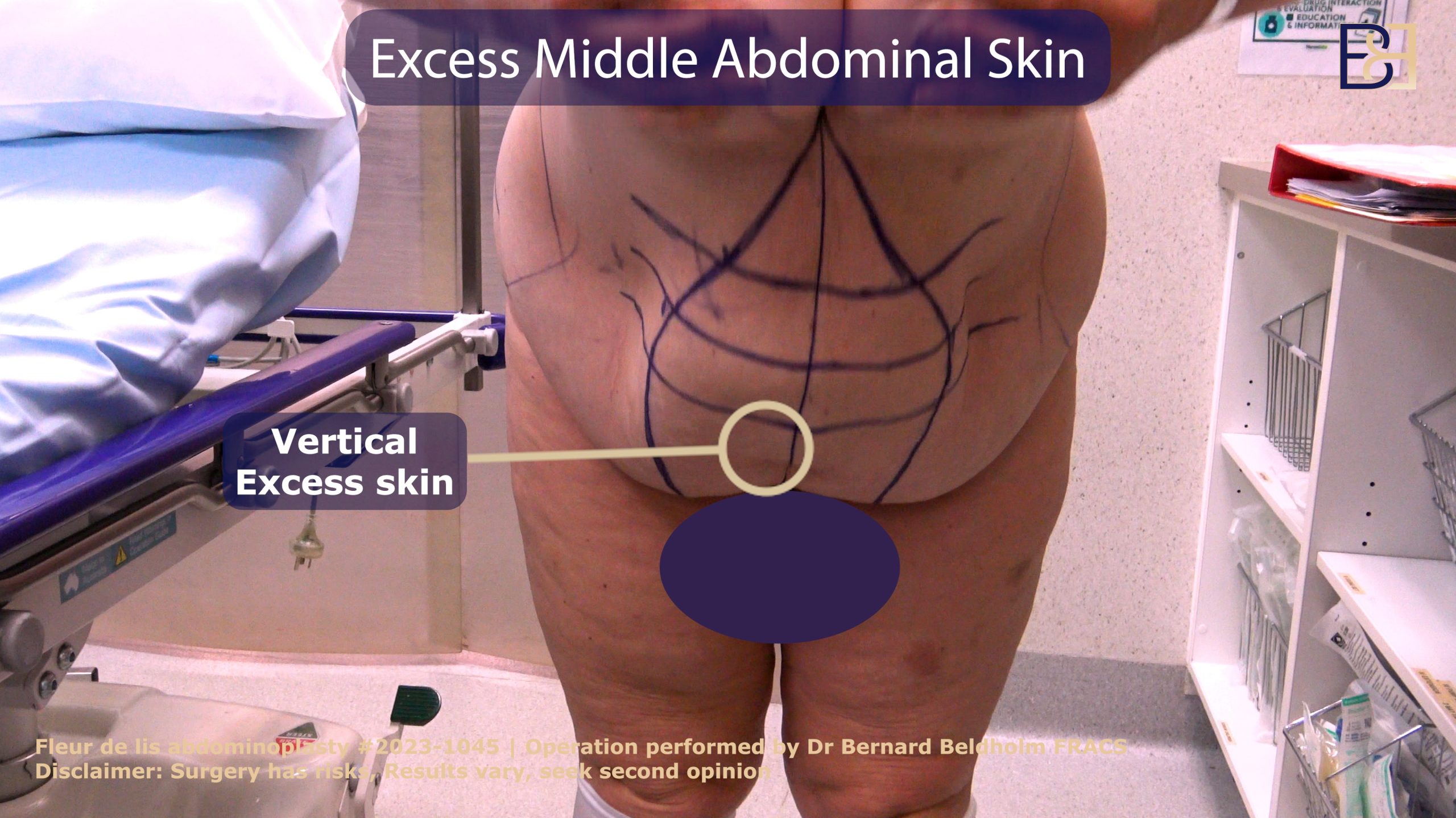 An illustration of various surgical techniques for vertical incision abdominoplasty, including incision styles.