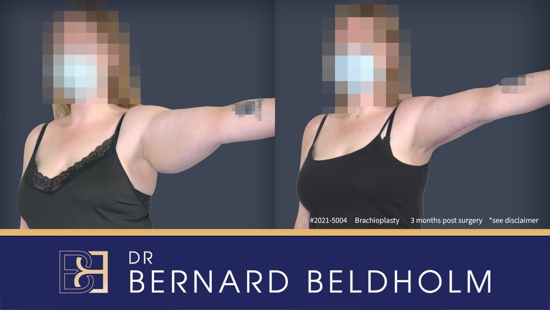 Scarring issues related to arm lifts and surgical procedures | Dr Beldholm