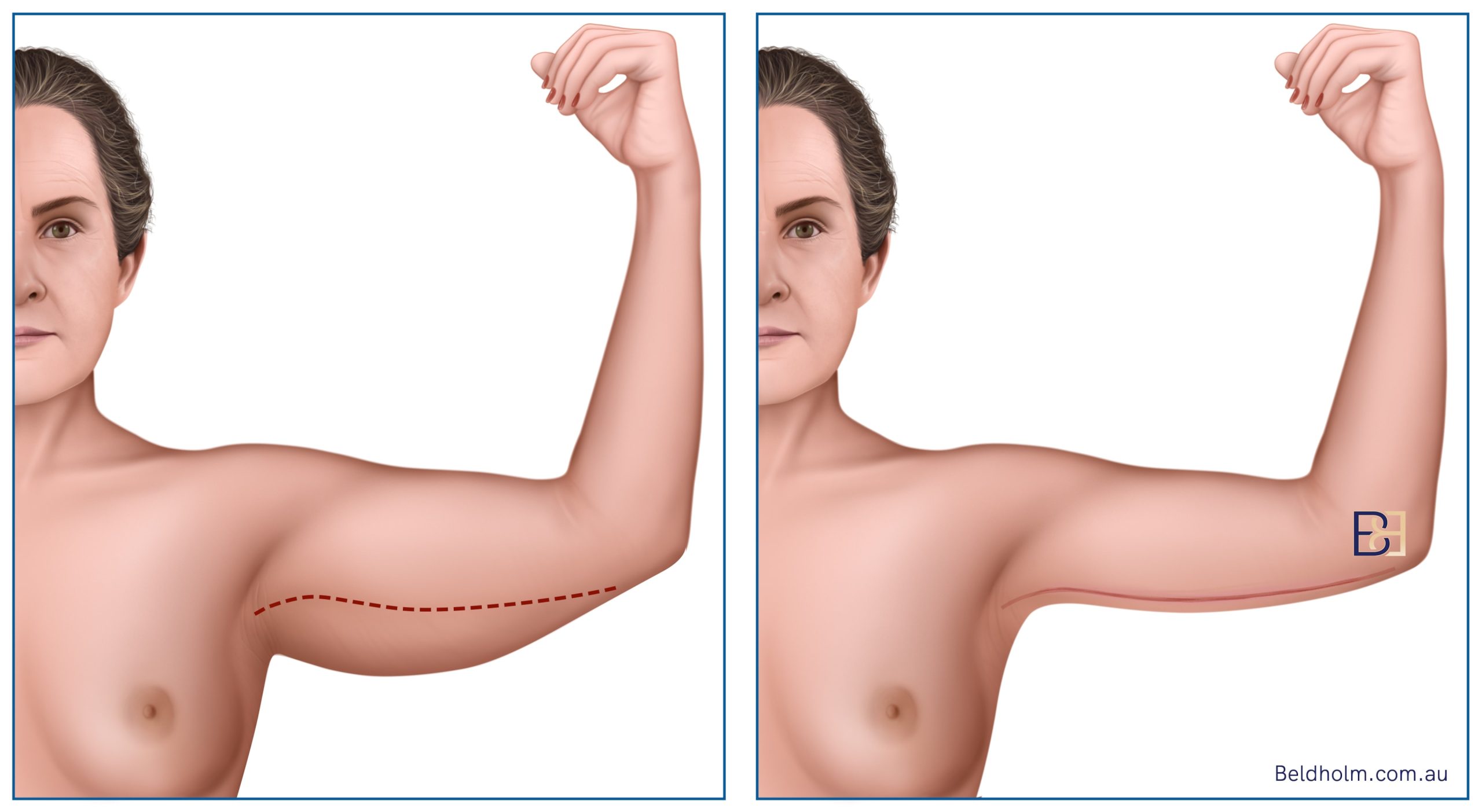 Standard brachioplasty (Arm lift) | Dr Bernard Beldholm