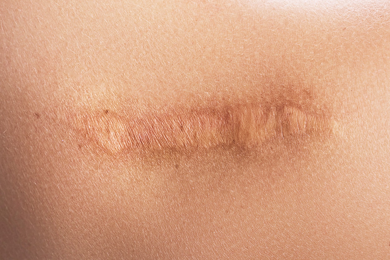 Wide scar | Dr Beldholm