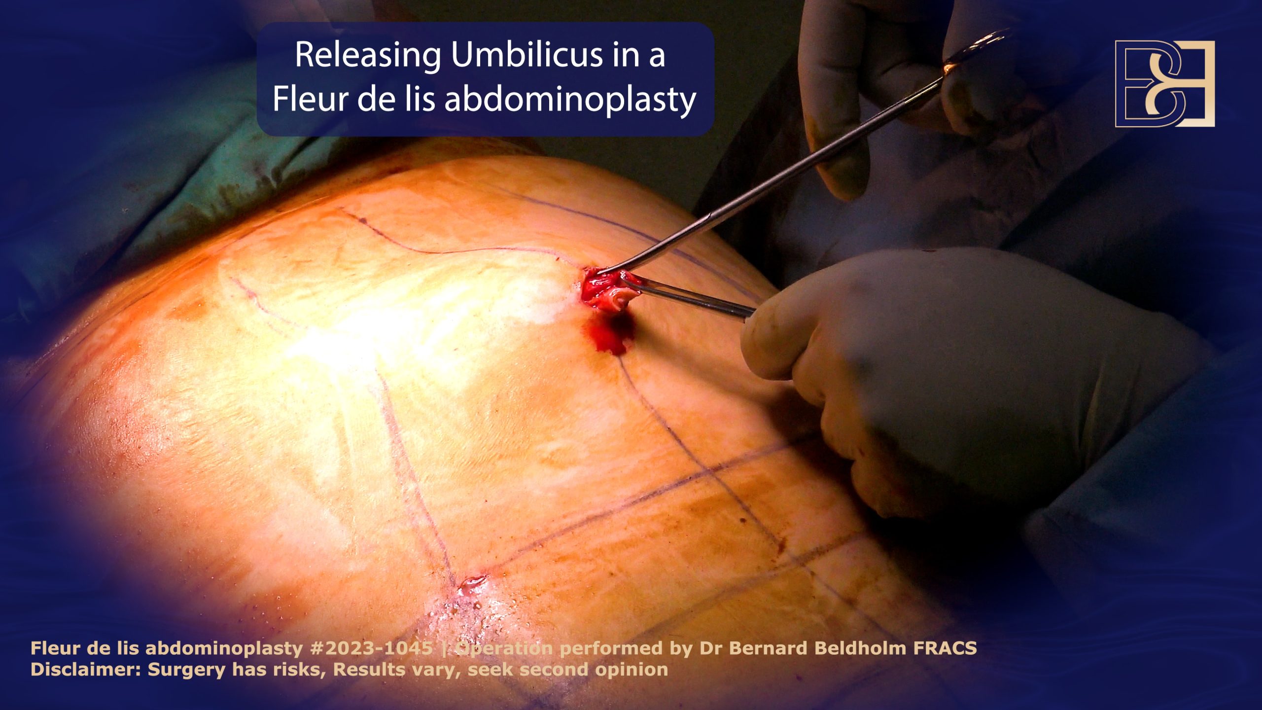 Releasin the umbilicus in a Fleur de lis abdominoplasty | Dr Beldholm