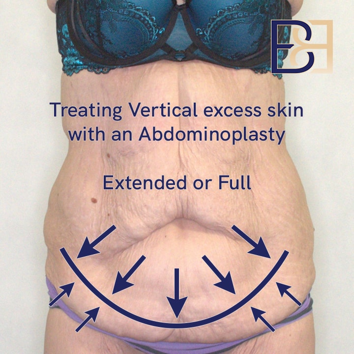 Treating excess vertical loose skin with an Abdominoplasty | Dr Beldholm