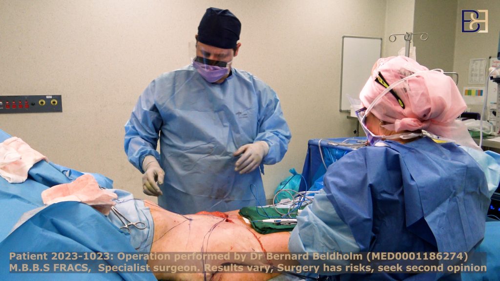 Dr Beldholm removing excess skin during body contouring surgical procedure