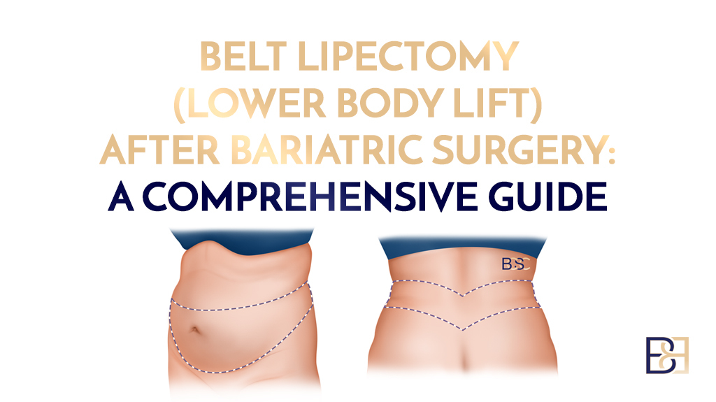 Lower Body Lift (Belt Lipectomy) After Bariatric Surgery: A Full Guide