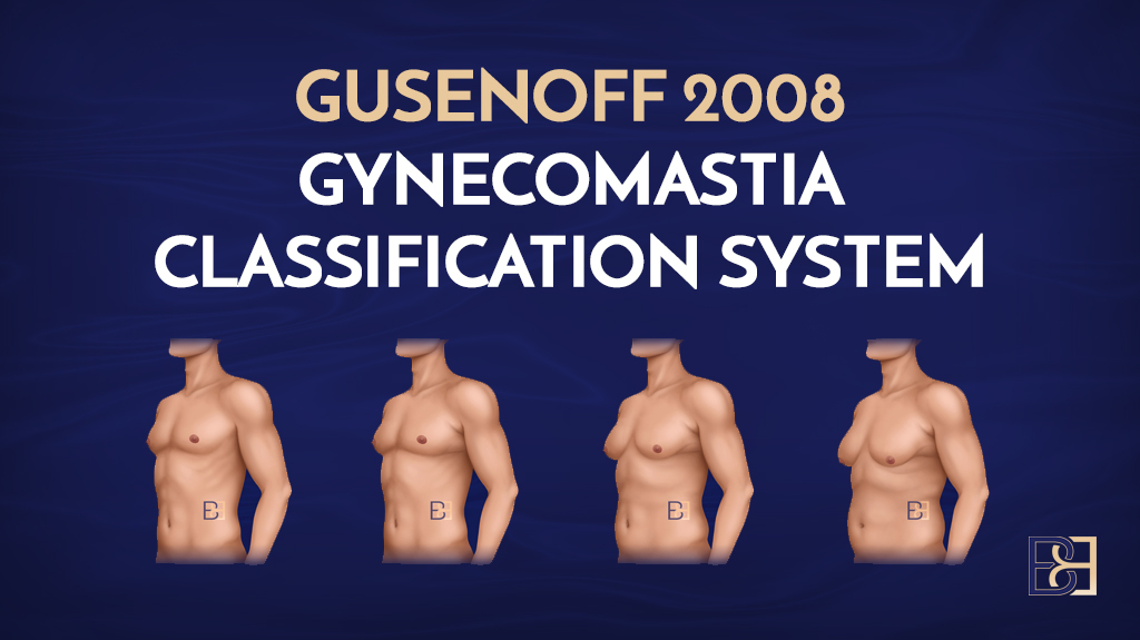 Gusenoff Gynecomastia Classification System (2008)