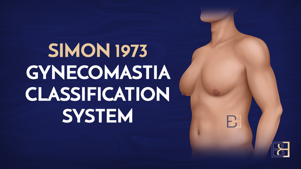 Simon (1973) Gynecomastia Classification System