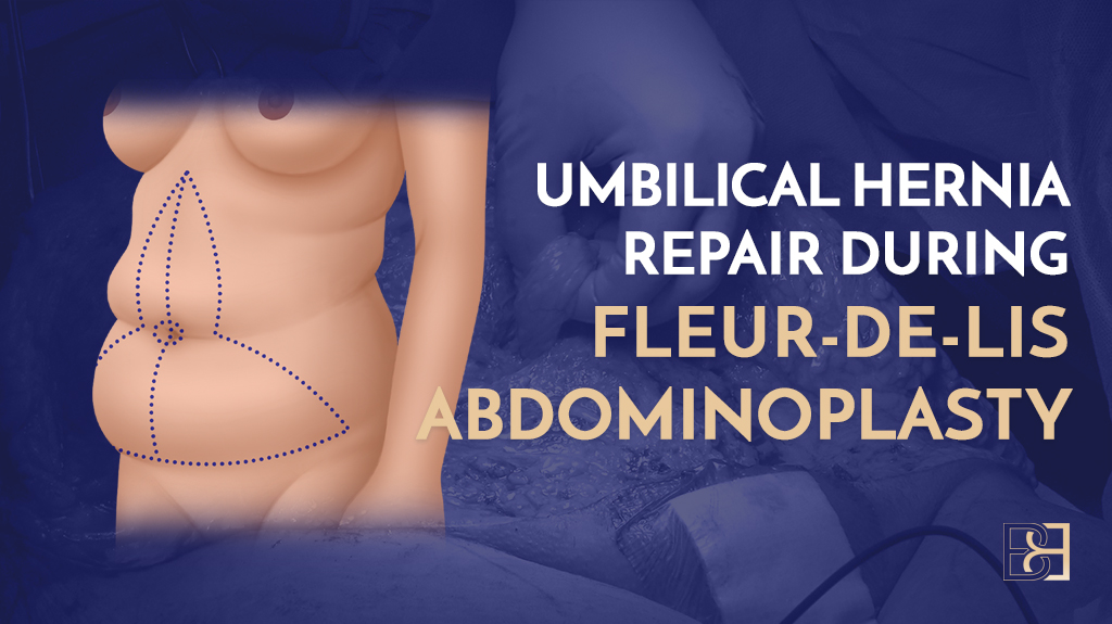 Umbilical Hernia Repair During Fleur-de-Lis Abdominoplasty
