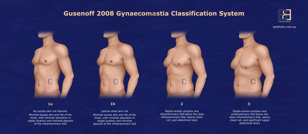 Gusenoff Gynecomastia Classification System