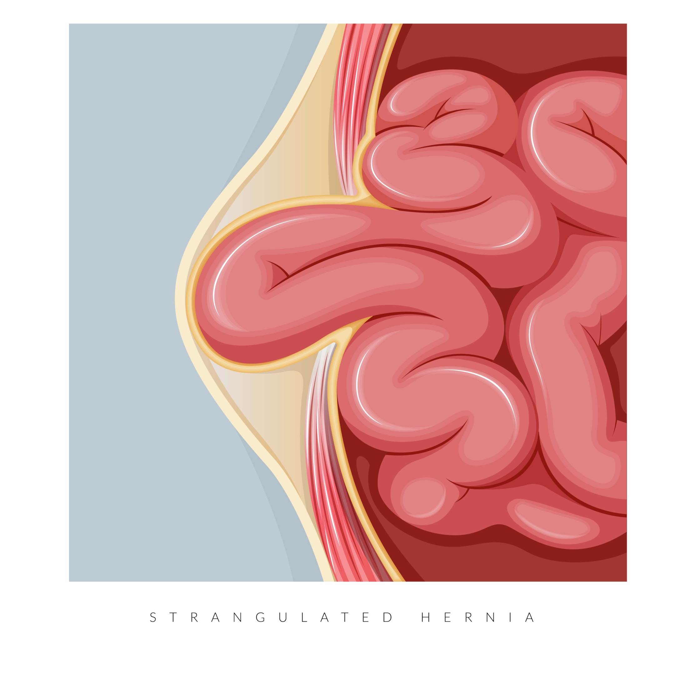 umbilical hernias