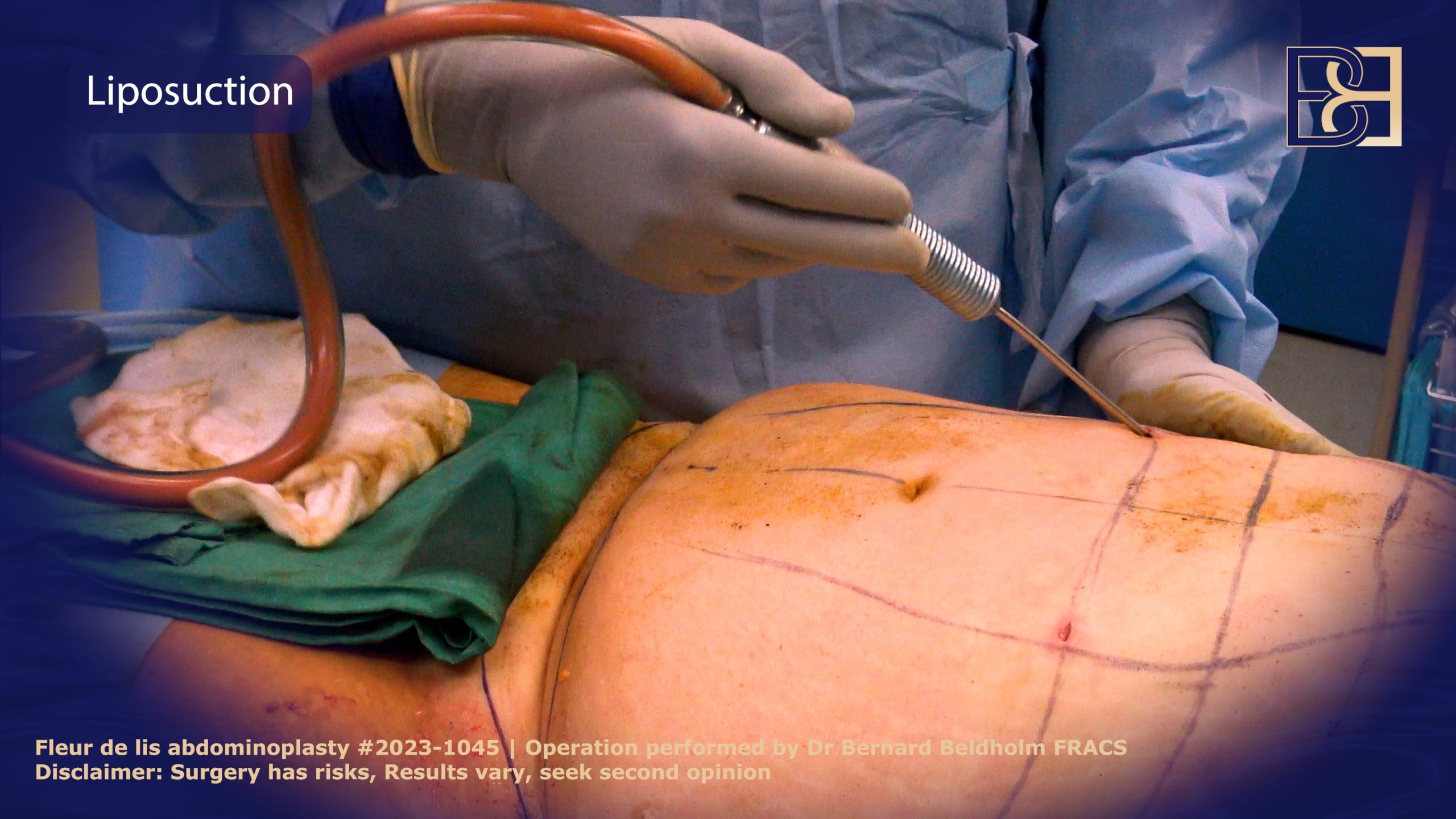 Dr Beldholm performing Liposuction