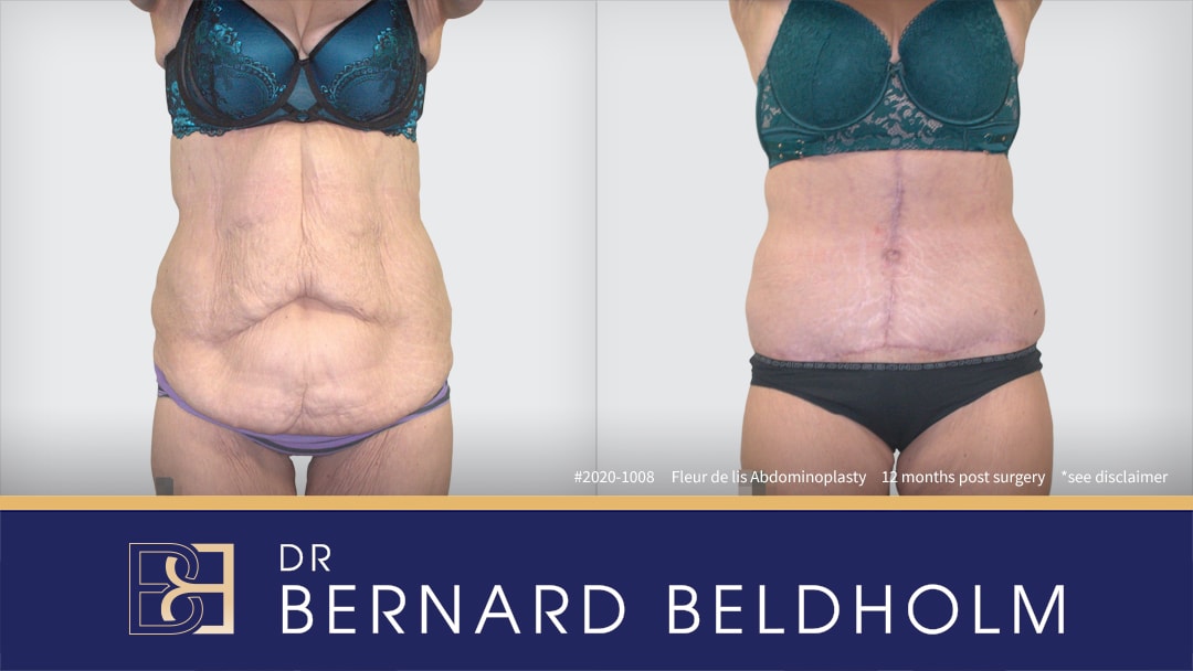 Fleur de lis abdominoplasty performed by Dr Beldholm