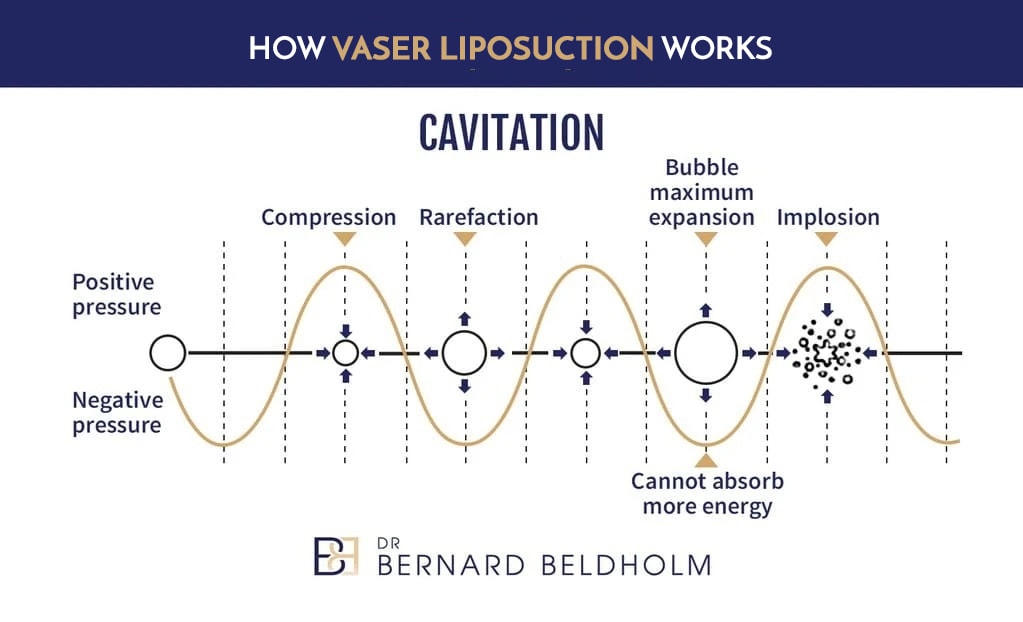 How VASER liposuction works