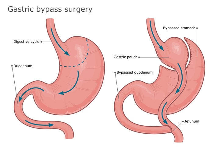 Gastric bypass surgery