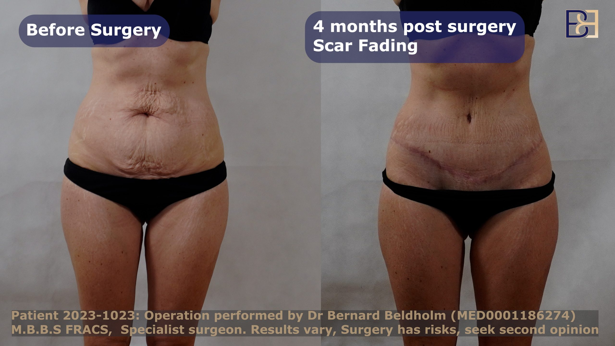 Scar 4 months post surgery. Operation performed by Dr Beldholm