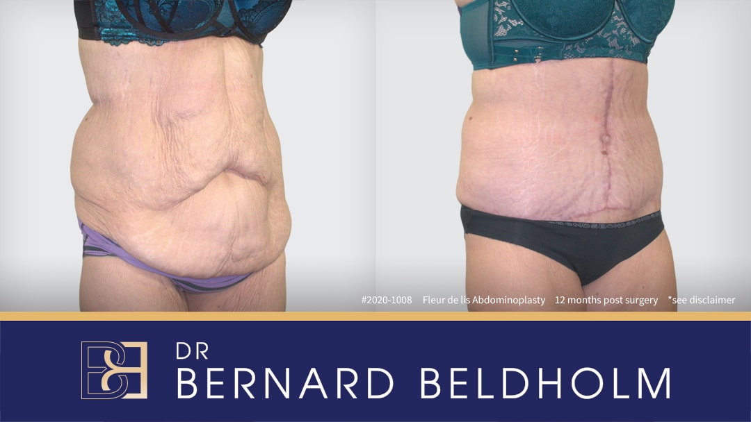 Fleur de lis abdominoplasty before and after performed by Dr Beldholm