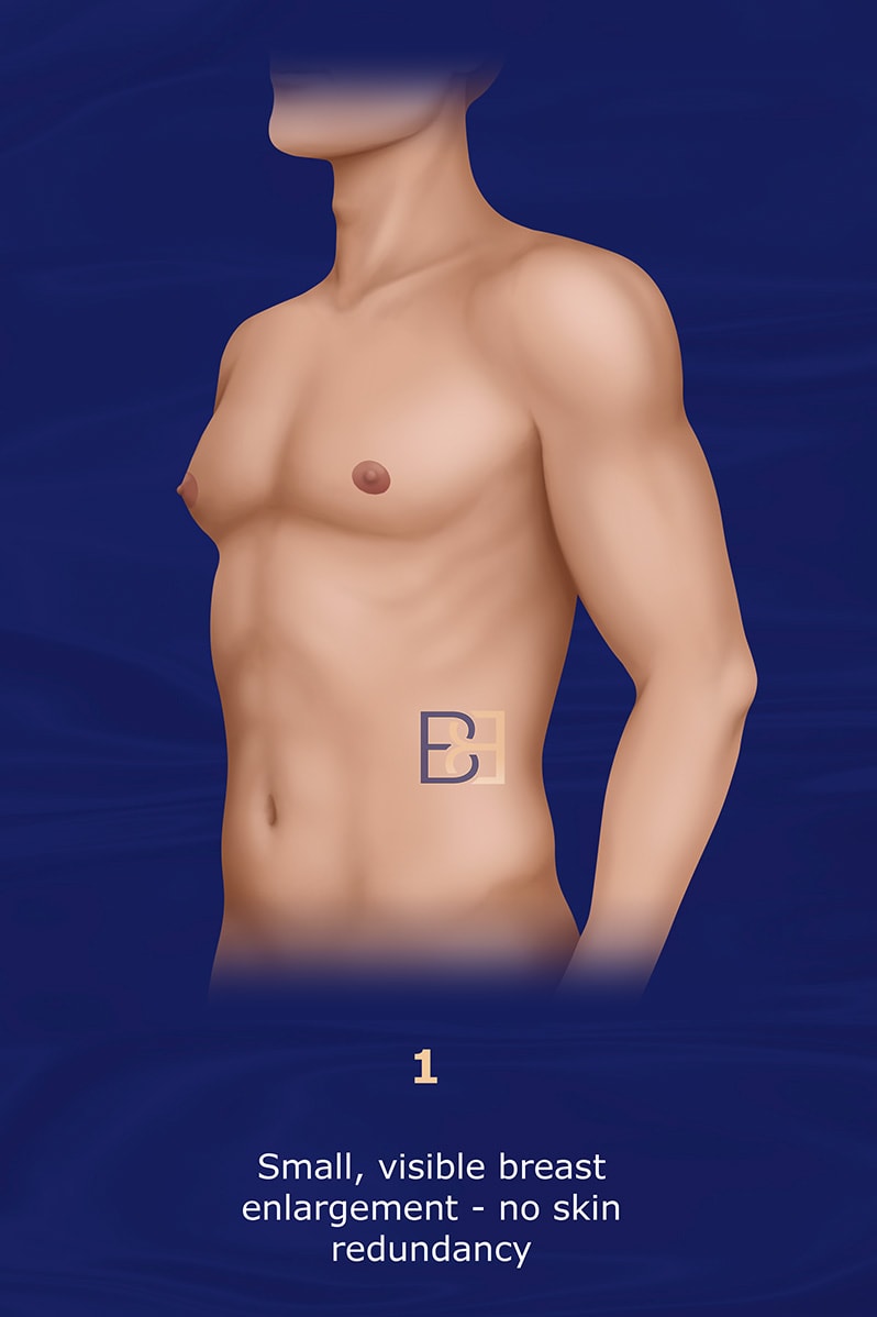 Grade 1 Simon Gynaecomastia Grading System (1973)