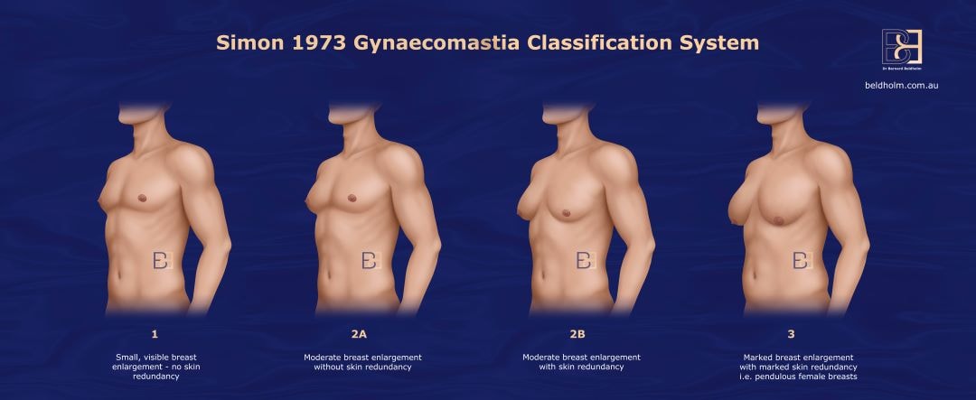 Simon Gynaecomastia Grading System