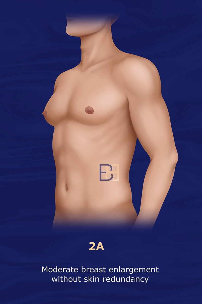 Grade 2A Simon Gynaecomastia Grading System (1973)