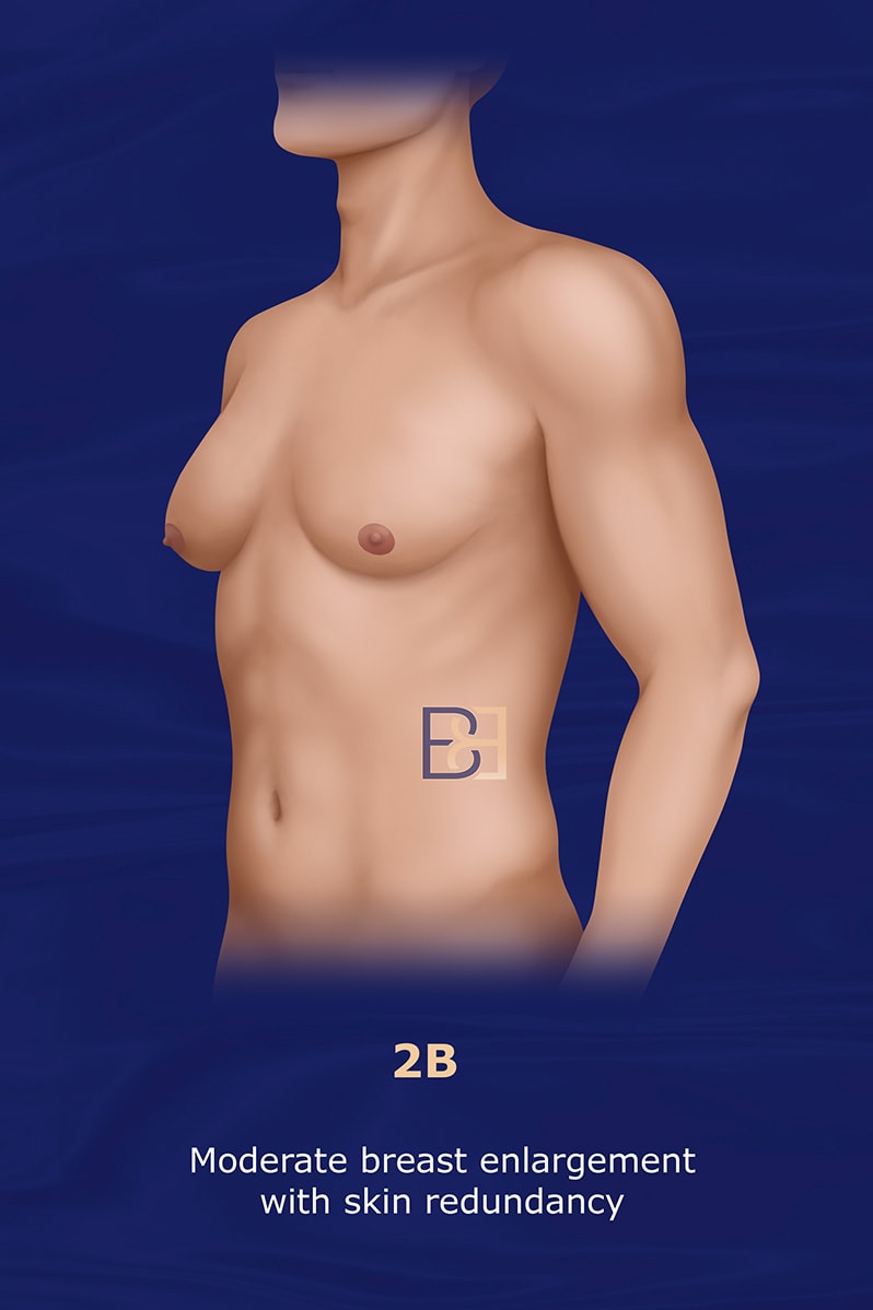 Grade 2B Simon Gynaecomastia Grading System (1973)