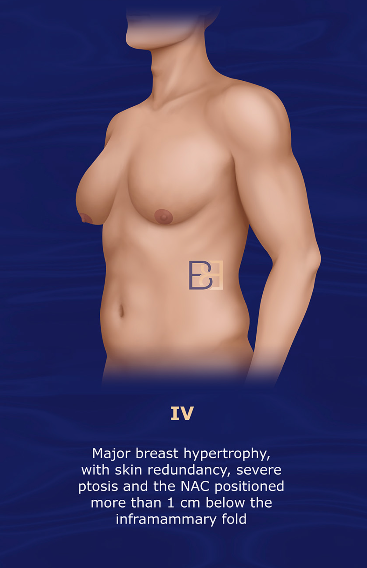 Barros grade IV gynecomastia | severe chest enlargement