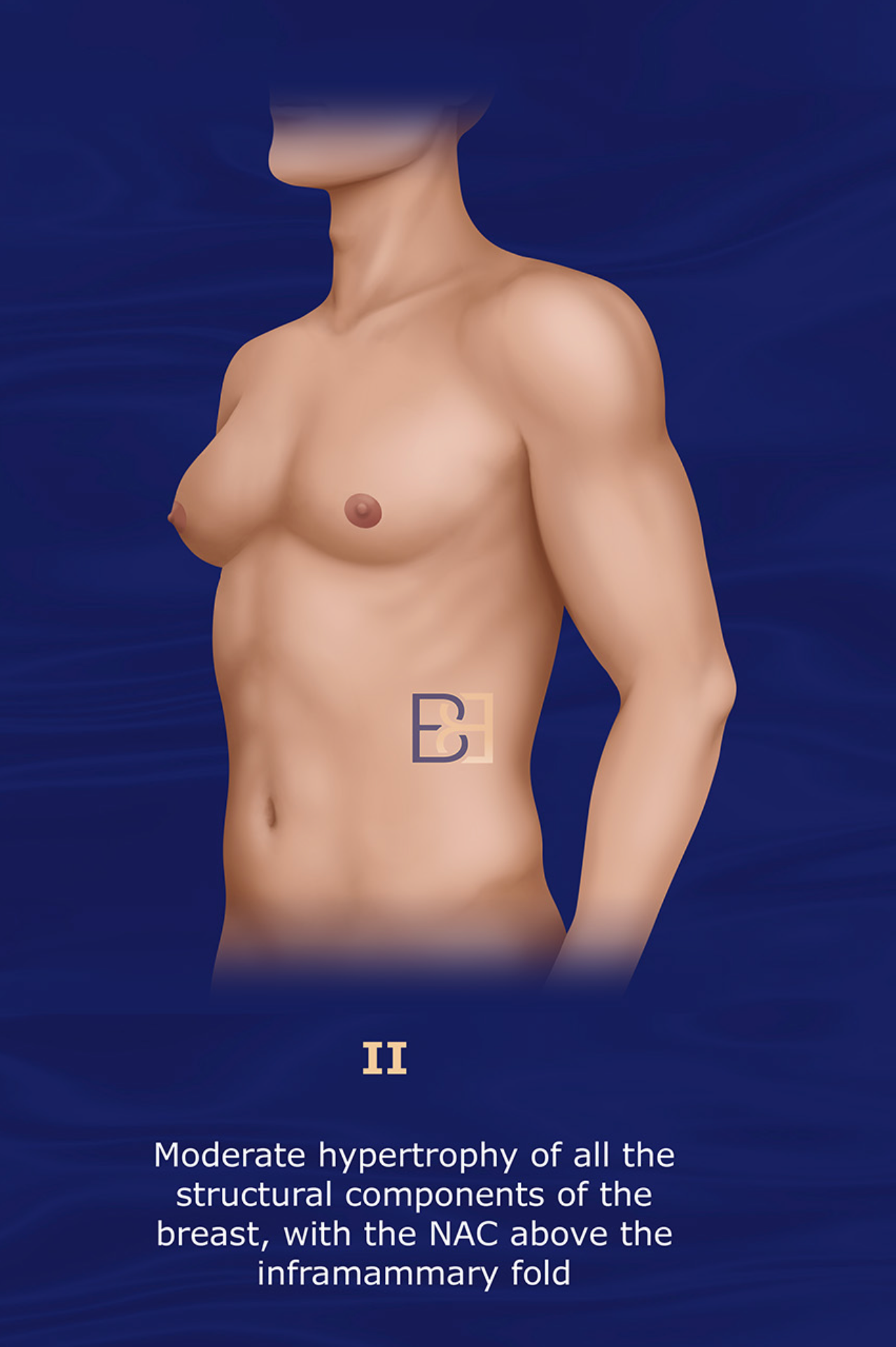 Barros grade II gynecomastia