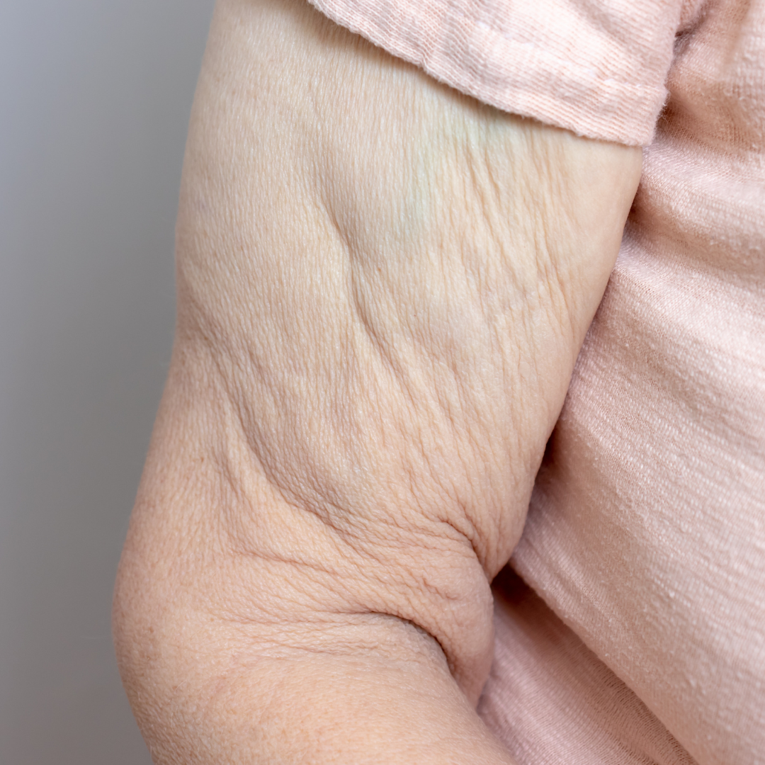 reduced skin elasticity on arms due to aging