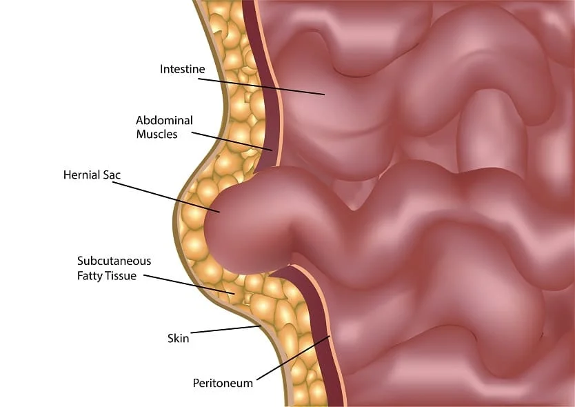 illustration of a hernia | Dr Beldholm