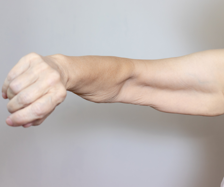 arm lift removes excess skin after weight loss