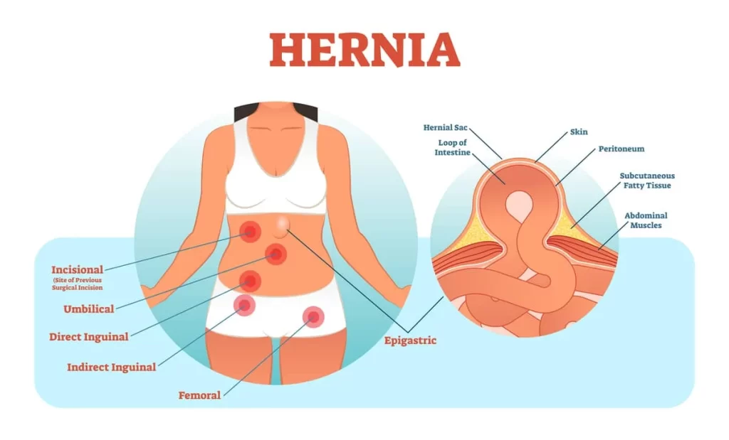 Different abdominal hernias | Dr Beldholm