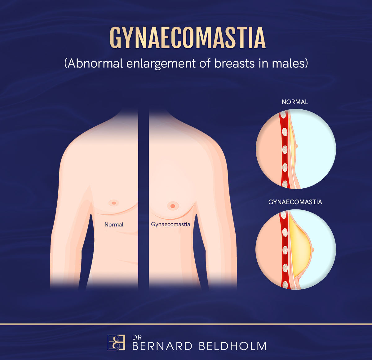 Gynaecoamstia - Abnormal enlargement of male breast gland