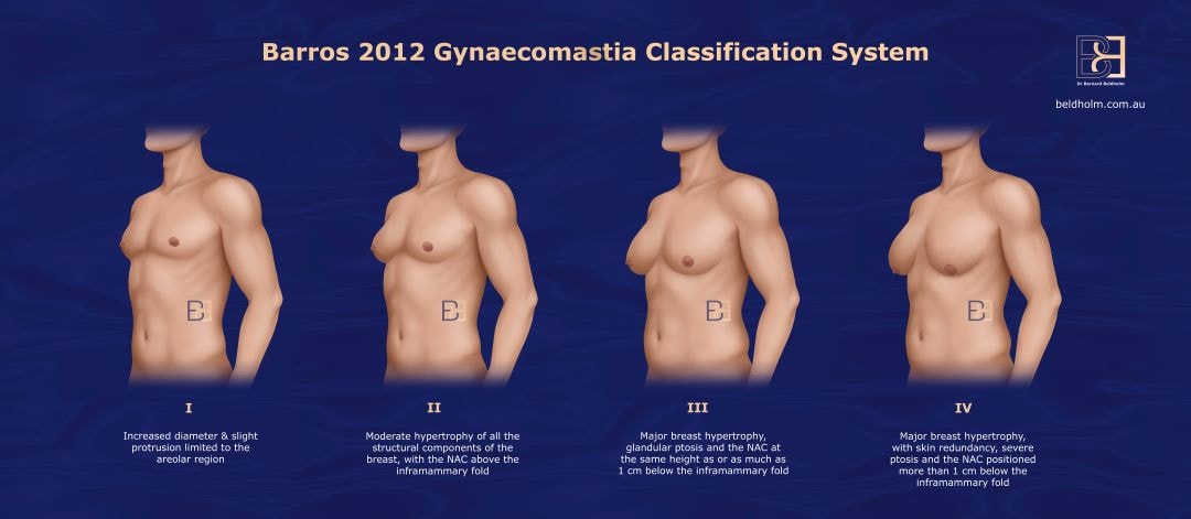 Barros 2012 Gynecomastia classification system