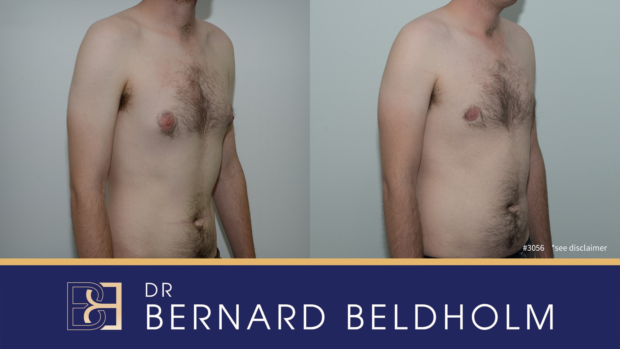 chronic gynecomastia | Before and after